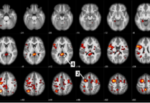 IBM and University of Alberta publish new data on machine learning algorithms to help predict schizophrenia
